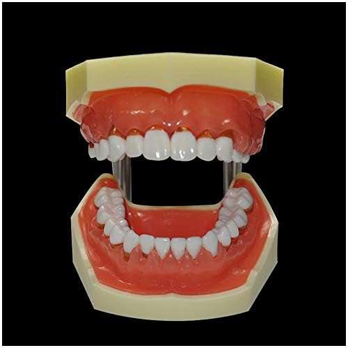Modelo de dentes de doença periodontal de KH66ZKY - Modelo Dental Typodont - Modelo de Lesões Dentárias de Lesões Periodontais