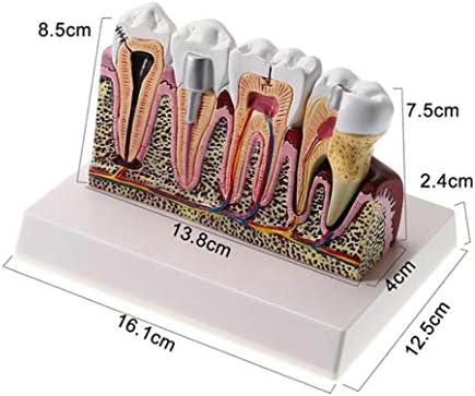 Modelos de anatomia da doença do Modelo Suzata 4x 4, modelos de combinação comuns de patologias, dente removível para