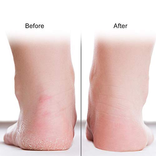1 par de meias hidratantes de gel de silicone anti -deslize Protetor de cuidados com os pés, evita fascite plantar e metatarsalgia,