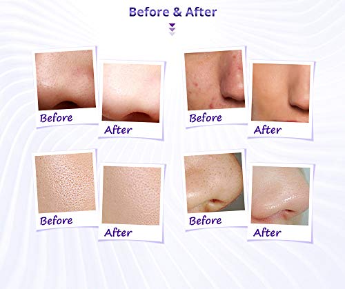 Diamond Microdermoabrasão Máquina de Dermobrasão 3 em 1 Skin Rejuvenesation Beauty Machine para acne Blackheads Pores