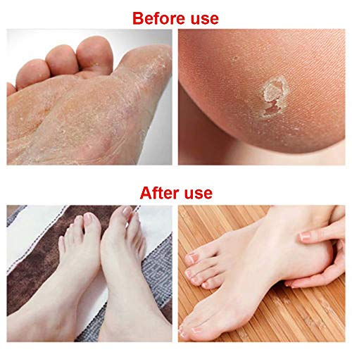 KQIANG 6PCS FOOD FILO PODO SUBSTITUIÇÃO BLADES PEDICULA PEDICURE BURO BIG AÇONENTE DE AÇO